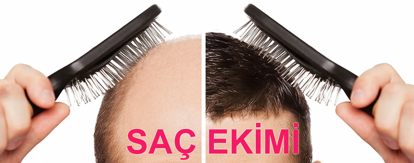 Saç Ekimi